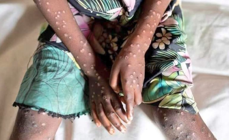 Mali : aucun cas de variole simienne signalé dans les établissements sanitaires selon le département de la santé