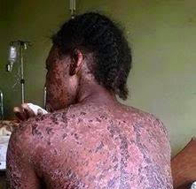 Dépigmentation : Entre idéal de beauté et danger pour la santé